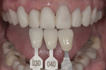 Figure 5 A silicone matrix of the diagnostic wax-up was used to fabricate provisional restorations.