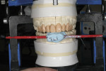 Figure 7 The stick bite was used to verify the vertical midline of the initial wax injection.