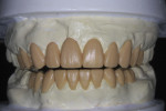 Figure 3 A diagnostic wax-up was completed to address both esthetic and functional concerns.