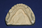 Figure 1 Stone cast of the mandibular arch.