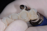 Edentulism: Dentures Are Not a Replacement for Teeth…Dentures Are a Replacement for NO Teeth! Webinar Thumbnail