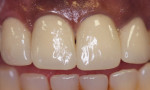 Figure 1. Maxillary anterior ceramic-noble metal crowns (lateral and central incisors) cemented with Ceramir Crown & Bridge cement, at 3-year recall.