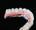 A lingual view of the finished maxillary acrylic and composite implant-supported hybrid.