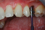 An impression coping (Straumann Bone Level NC implant) was placed prior to open-tray impression-taking.