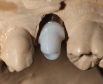View of the IPS e.max Pressed hybrid abutment on the model. The pressed hybrid abutment crown was cut back for layering.