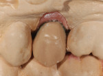 A full-contour wax-up of the IPS e.max Press crown restoration
was created on the stained abutment.