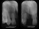 Figure 2  Radiographs of the central incisors area and nasopalatine canal (Case 1).