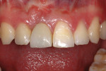Figure 7  The provisional crown on the right central incisor 1 year after initial graft.