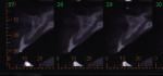 Figure 8  Cone beam image scan showing the atrophic ridge and wide nasopalatine canal.