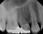 Figure 2. Preoperative radiograph of tooth No. A in the No. 4 position
(recurrent caries).