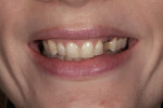 Figure 4. A composite mock-up was done to evaluate the final tooth length and shape and the patient’s function.