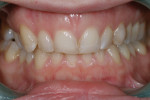 Figure 3. Pretreatment retracted photograph showing uneven gingival architecture and the dark color of deciduous canine H.