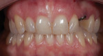 Figure 5. After implant placement and orthodontic treatment, the teeth were in good position for conservative porcelain veneer restorations.