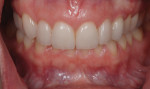 Figure 13. Photograph taken 2 months after insertion shows gingival maturation around teeth Nos. 7 through 9 and harmonious gingival color at the No. 11 position.