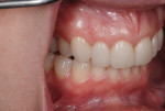 Figure 14. The shade match of the porcelain restorations was excellent when compared to the patient’s natural teeth.
