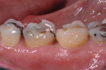 Figure 1. With the patient's history of teeth grinding and breaking enamel and porcelain, full-contour zirconia crowns were planned for the first and second molars.