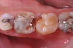 Figure 2. The patient chose a tooth-colored option instead of gold restorations. With a history of broken PFM crowns in other quadrants, a more durable restoration was needed.