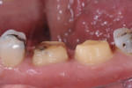 Figure 6. The margins were left supragingival where possible and all sharp points were rounded to reduce internal stresses on the restorations.