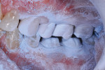 Figure 7. A titanium dioxide powder was applied, and both quadrants as well as the occlusal bite were digitally captured in the impression.