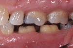 Figure 5. A tapered diamond was used to complete the preparation, leaving a 1-mm to 1.5-mm occlusal clearance, 3-mm to 4-mm axial wall height, and 4 to 8 degrees of taper.