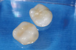 Figure 11. BruxZir monolithic zirconia restorations provided high strength with amply sufficient esthetics.
