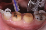Figure 13. Before cementation, the teeth were isolated, rinsed, and dried until moist.