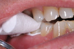 Figure 15. The restorations were placed with light occlusal pressure. Clean-up required about 2 minutes.