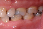 Figure 3. Parafunctional habits, occlusion, and the esthetic demands of the patient all factored into the choice of restoration materials. The first molars were edge-to-edge in occlusion.