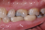 Figure 18. Occlusion is a critical factor in material selection and, in this case, the monolithic zirconia has provided years of esthetic restorative success.