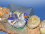Figure 11 The restoration proposed by CEREC SW 4.0.