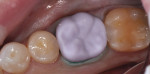 Figure 16 The restoration turned a natural tooth color, and was placed into the patient’s mouth with a fourth-generation bonding agent and resin cement.