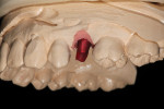Figure 1 The Ti base with waxing channel was placed on the model before creating the abutment wax-up.