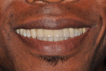 Figure 18  Full-smile view of final restorations.