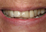 Figure 2 Preoperative close-up of the patient’s smile. Note the projection of her anterior teeth, the narrowing of her maxillary arch, and the way her incisors do not follow the curvature of the lower lip.