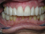 Figure 13 Patient wearing preliminary temporary veneers, before polishing, glazing, and use of the additive/reductive method to individualize the original wax-up to better balance any asymmetry.