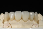 Figure 7 High translucency IPS e.max restorations were made over abutments and natural teeth.