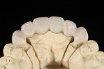 Figure 11 Thin facial layering provides translucency, while full lingual contour zirconia provides durability.