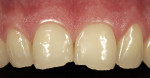 Figure 2   A color mismatch existed between old Class III restorations and the natural tooth structure.