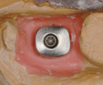 These abutments were designed on the NobelProcera scanner with undercuts and finished with cross-cut carbides to soften any sharp edges. (Note: finish line is well below the gum line in order to hide any metal show-through).