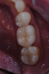 Occlusal aspect of mandibular crown.