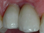 ATLANTIS Abutments were then torqued in and the Captek restorations were luted into place.