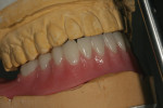 The processed and finished implant overdenture.