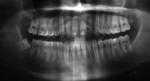 Figure 3  (Case 1) Postoperative panoramic radiograph taken after orthodontic therapy in 2005. Note transient apical breakdown of mandibular anteriors from orthodontic therapy.<sup>2</sup>