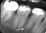 Figure 18  (Case 5) Periapical radiograph from 2004. Note PARR of distal root of the mandibular right first molar, caries in distal interproximal, and tooth treated with porcelain-fused-to-metal (PFM) crown.