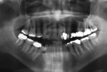 Figure 19  (Case 5) Panoramic radiograph from 2010 showing PARR limited to the distal roots of the mandibular right and mandibular left first molars.