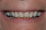 Figure 2. Worn, chipped, and retruded maxillary anterior teeth were evident in this close-up smile image.
