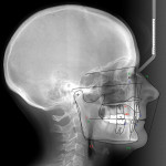 Figure 5. Excessive interincisal angle of 165 degrees is shown on this preoperative tracing.