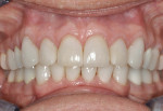 Figure 13. Postoperative photo showing excellent gingival health and symmetry.