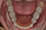 Figure 11. Lower arch after treatment completion.
