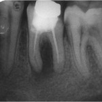 Figure 1  Preoperative radiograph with evidence of periapical and furcation pathosis.